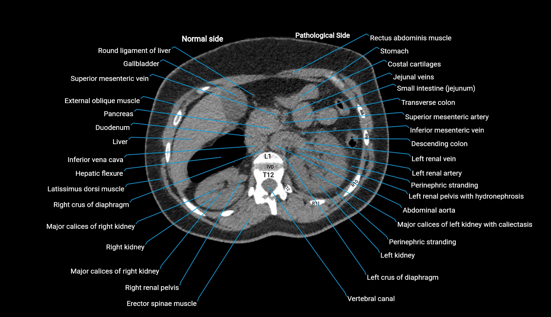 CT KUB axial cross sectional anatomy  radiology image -img-00201-00035.webp